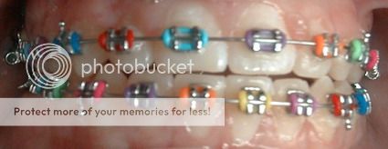 http://i1143.photobucket.com/albums/n627/thedogcody/Braces-color_zps85a0691f.jpg