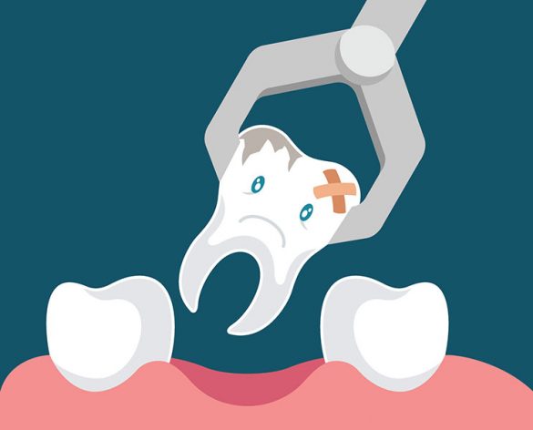 Tooth extraction amp tooth removal 7 days a week in Kingston London